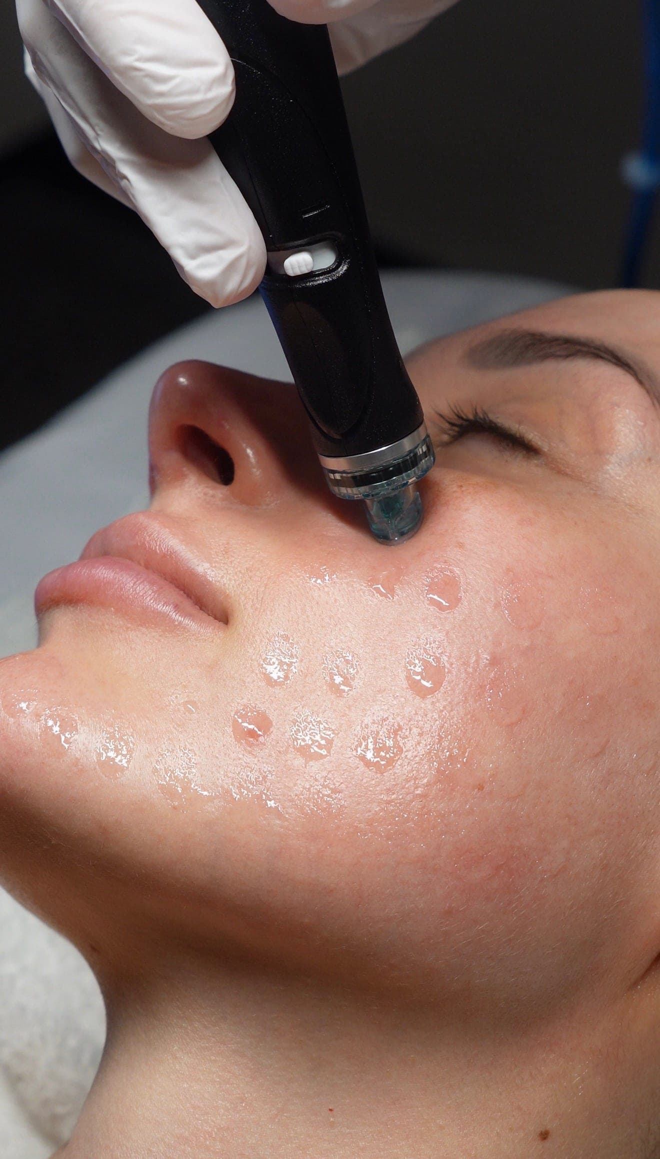 HydraFacial serum droplets on a client's skin at Skin Study Med Spa in Plano, TX