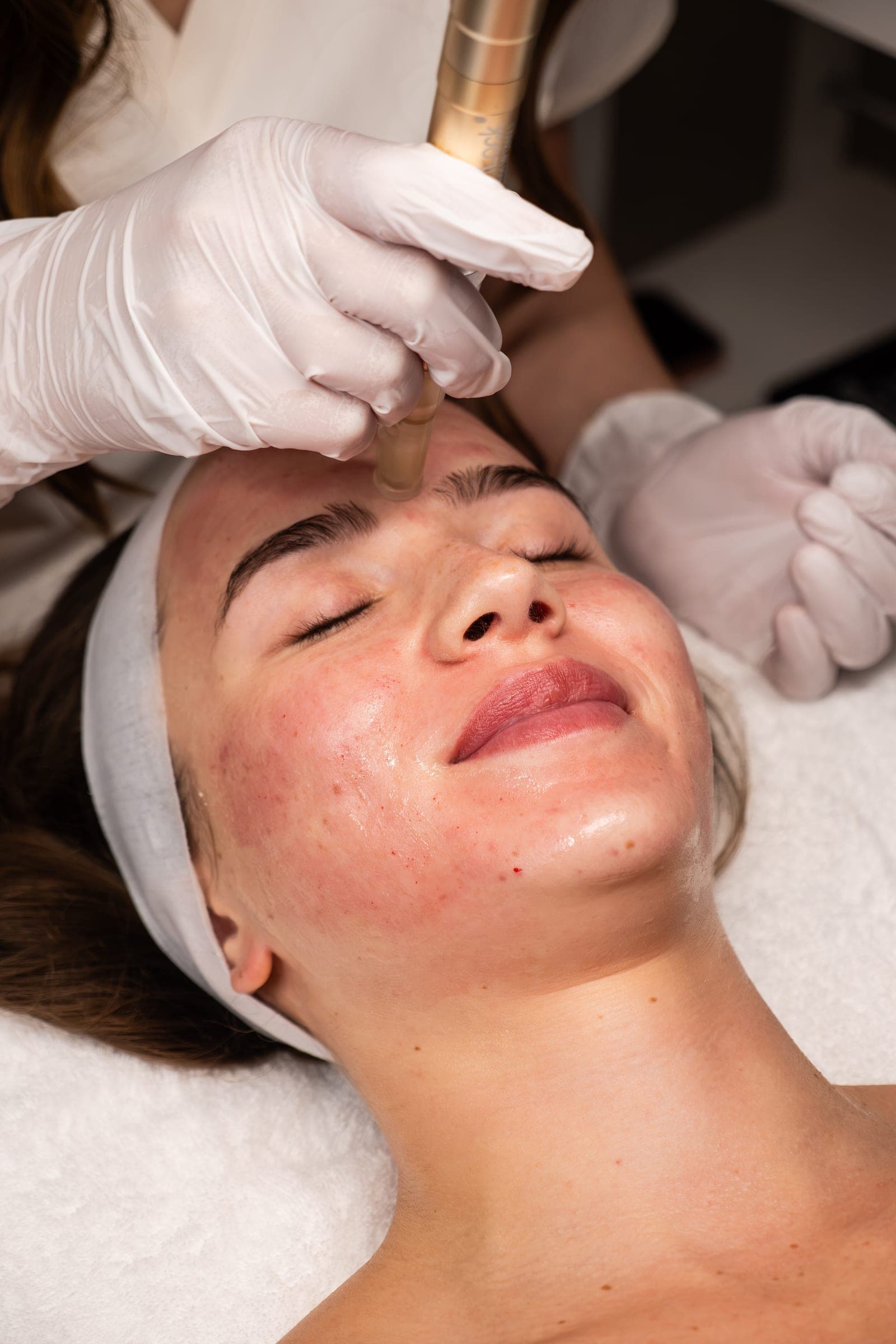 Microneedling treatment being performed at Skin Study Med Spa in Plano, TX